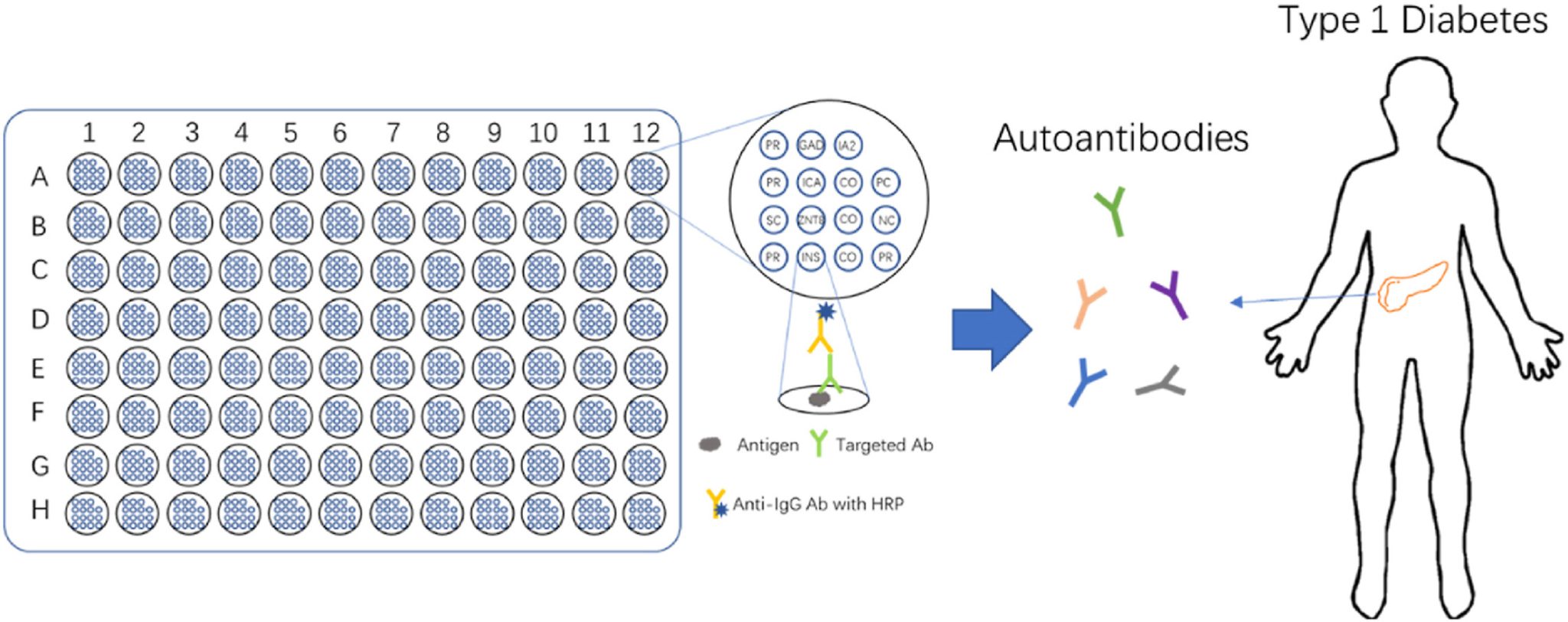 Type 1 Diabetes Autoantibody Diagnosis Creative Diagnostics