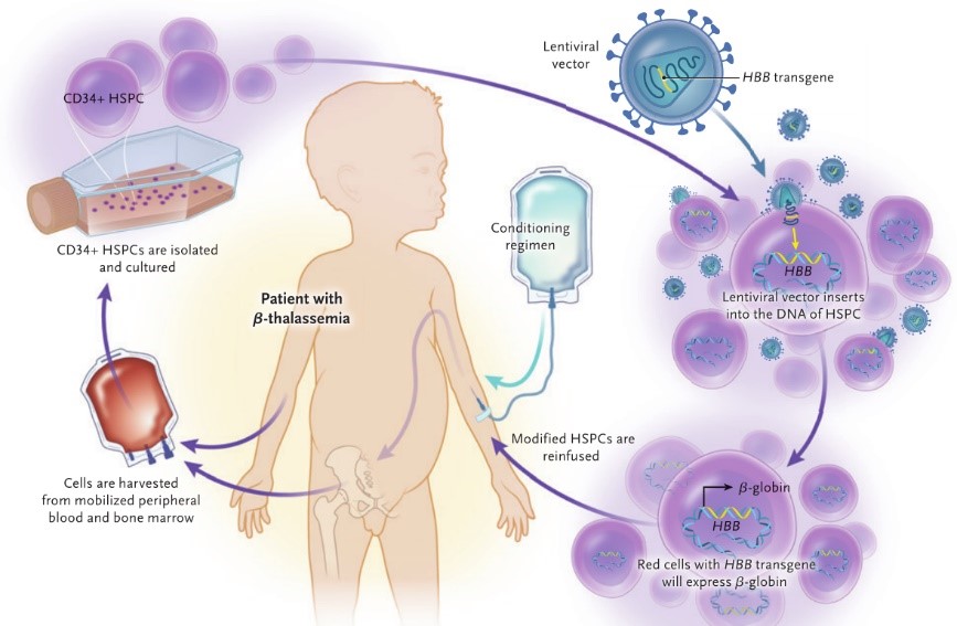 Ex Vivo Delivery of Gene Therapy.