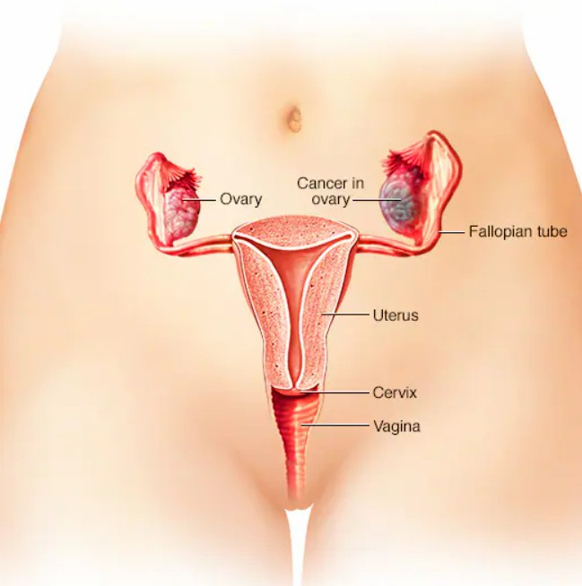 Ovarian Cancer Creative Diagnostics