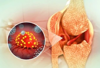 Pathological examination of Bone Cancer