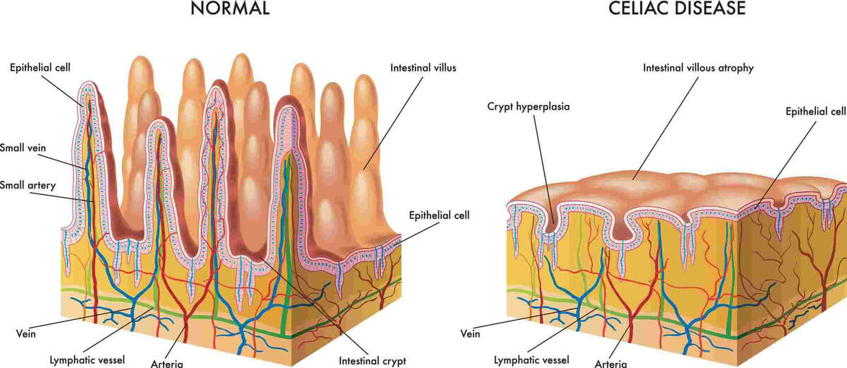 Medical illustration of the modification of the intestinal mucosa in celiac subject.