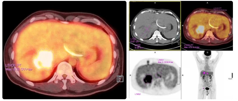 Cholangiocarcinoma