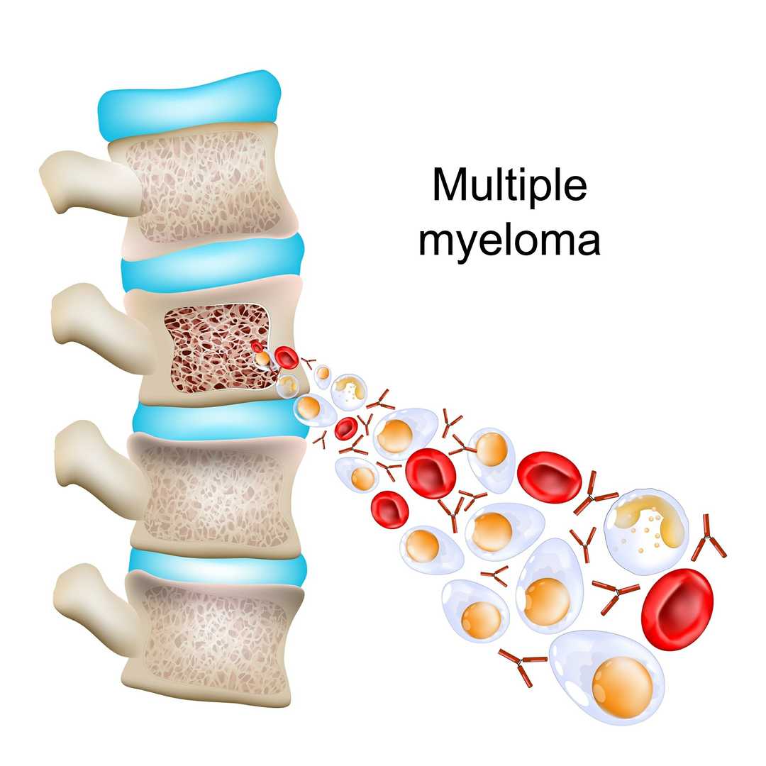 Multiple Myeloma
